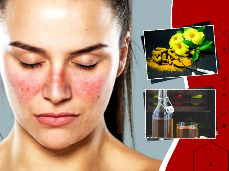 Suffering From Lupus Disorder? Here Are 7 Home Remedies To Treat This Condition