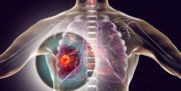 non_small_cell_lung_cancer