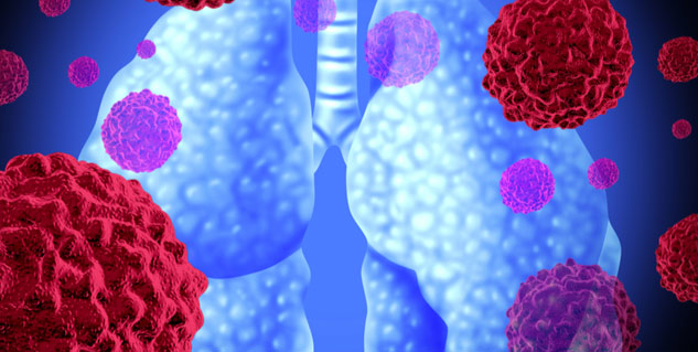 Small cell lung cancer stages