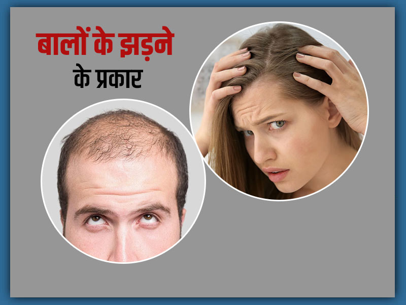 Discover 146+ hair loss kyu hota hai best tnbvietnam.edu.vn