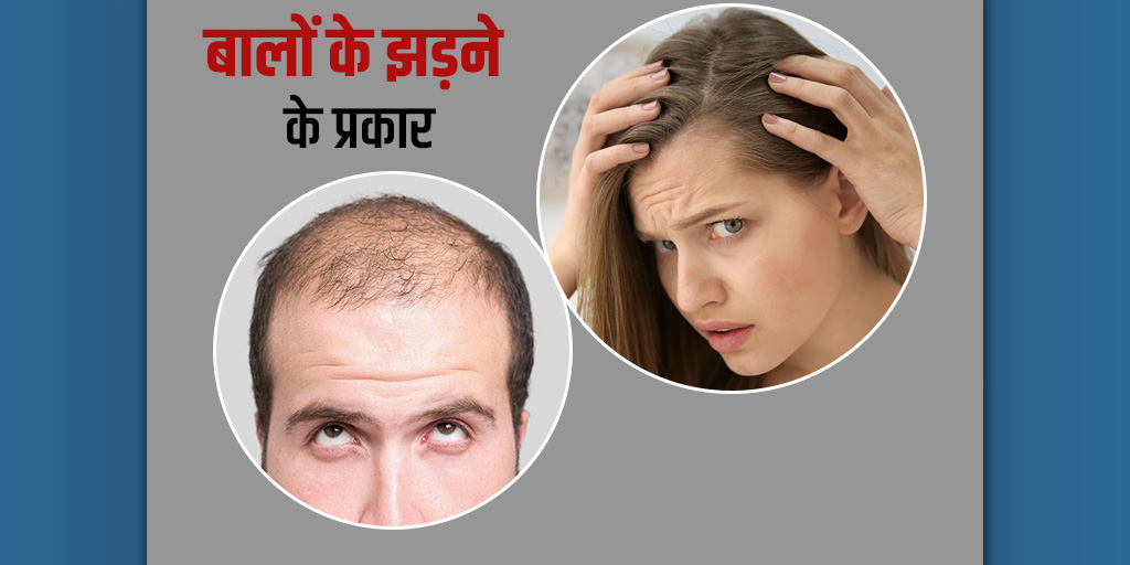 Hair Loss Types in Hindi | हेयर लॉस के प्रकार और बचाव के उपाय