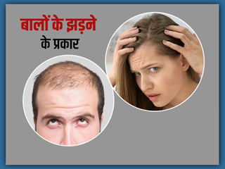 आम होती जा रही है बाल झड़ने की समस्या, जानें कितने प्रकार के होते हैं हेयर लॉस और इन्हें कैसे पहचानें