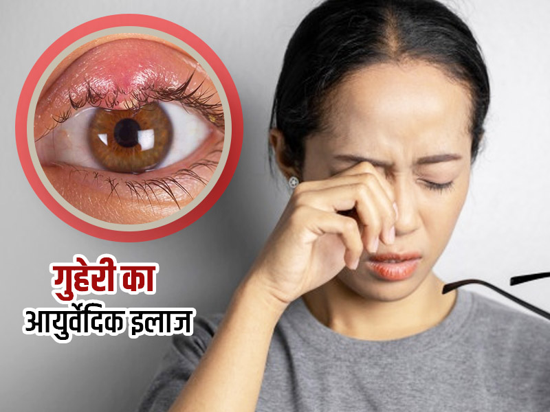 गुहेरी का आयुर्वेदिक इलाज: आंख में फुंसी (बिलनी) होने पर अपनाएं ये 9 आयुर्वेदिक उपाय, समस्या से मिलेगी राहत