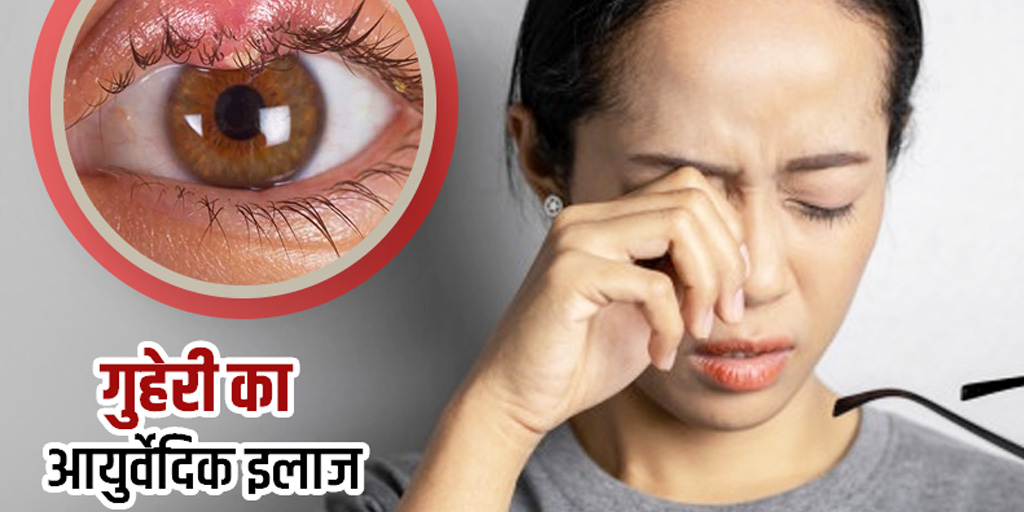 Ayurvedic Remedies to Cure Stye in Eye in Hindi गुहेरी का आयुर्वेदिक