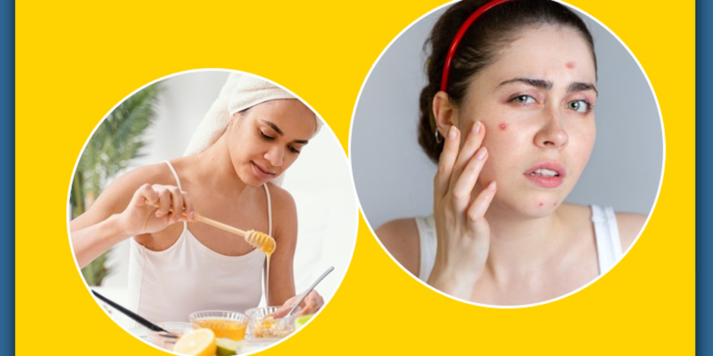 Try Out These Natural Supplements to Reduce Acne Scars Onlymyhealth