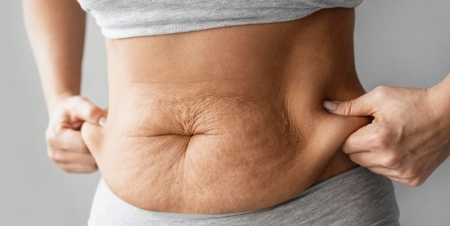 Stretch-marks-coconut-oil