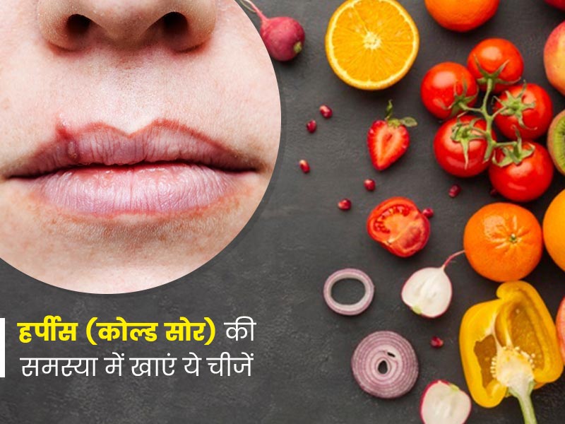 हर्पीस (कोल्ड सोर) में क्या खाना चाहिए और क्या नहीं, एक्सपर्ट से जानें डाइट टिप्स