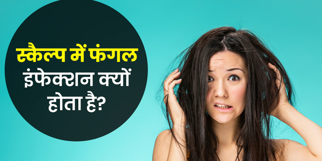 scalp fungal infection causes symptoms treatment in hindi। स्कैल्प में फंगल  इंफेक्शन के कारण और उपचार