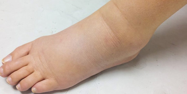 water retention in legs