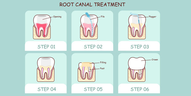 root canal