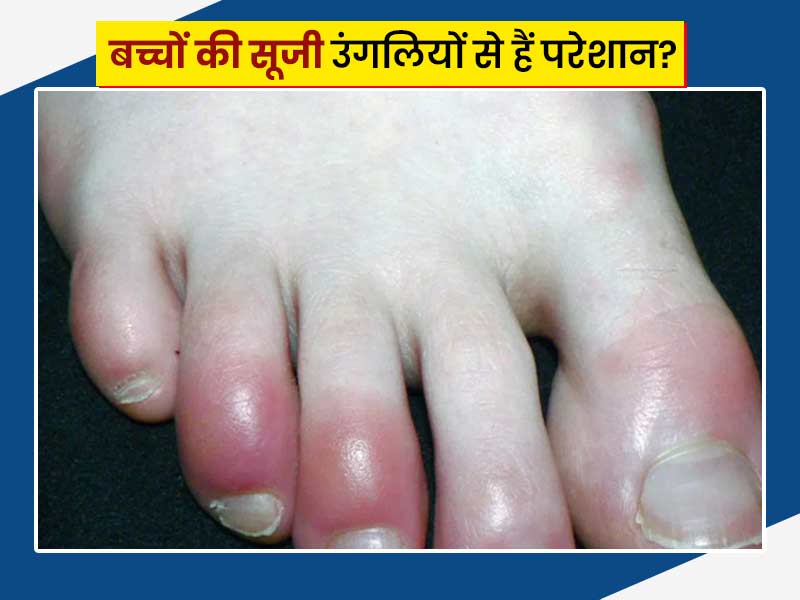 सर्दी में बच्चों की उंगलियों में सूजन की हो समस्या तो अपनाएं ये 7 घरेलू उपाय