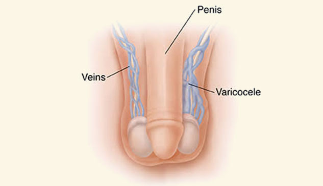 nirogam Varicocele Kit  Treatment for Varicocele,Piles,Digestive