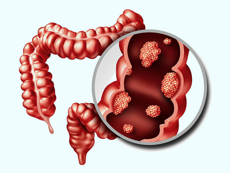 Role Of Fibre In Preventing Colon Cancer, Know From Expert 