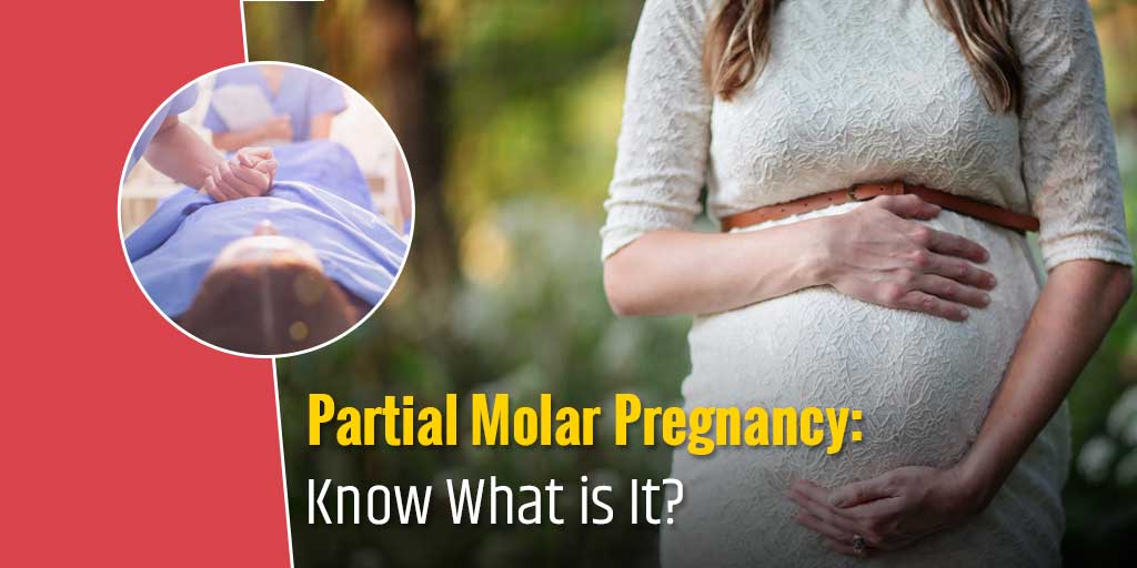 Partial Molar Pregnancy: Symptoms, Causes And Treatment | Onlymyhealth