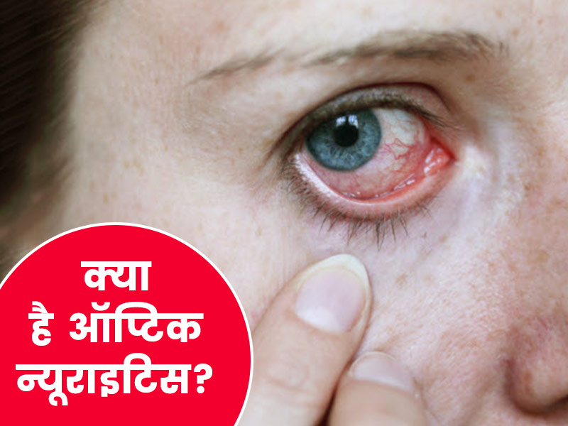 क्या है ऑप्टिक न्यूराइटिस? जानें कारण, लक्षण और उपचार