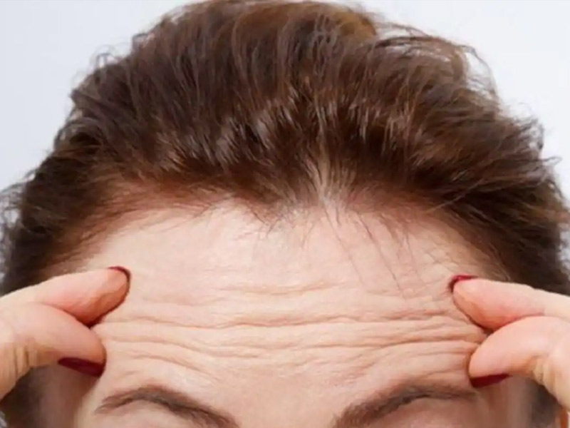 Here's How You Can Prevent And Get Rid Of Fine Lines on Forehead