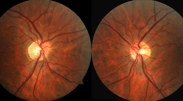 inside1Opticneuritiscauses