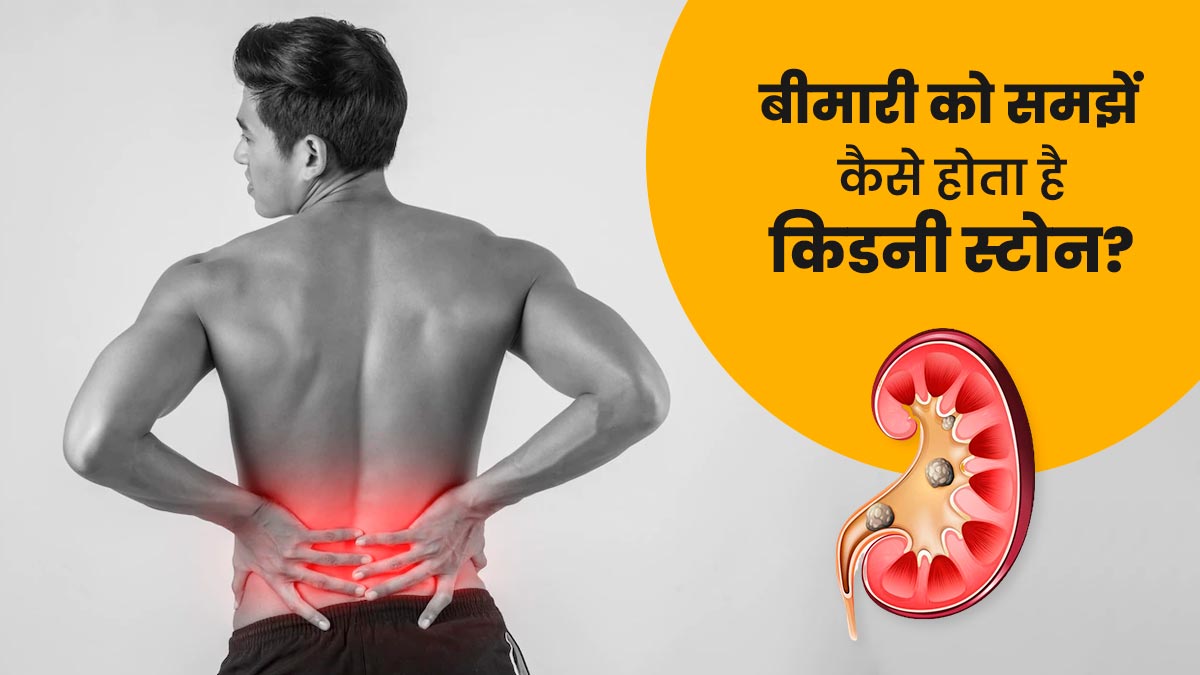 किडनी में पथरी क्यों होती है? आसान भाषा में समझें कैसे जमा हो जाते हैं शरीर में पत्थर