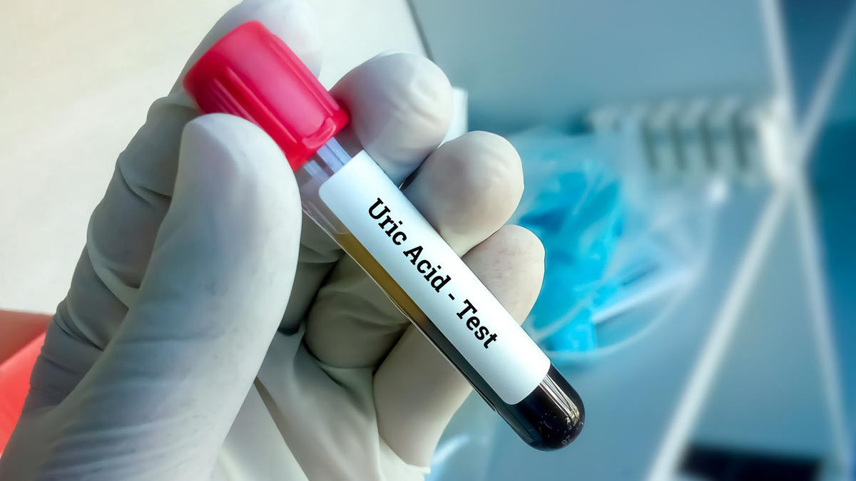 Uric Acid Test