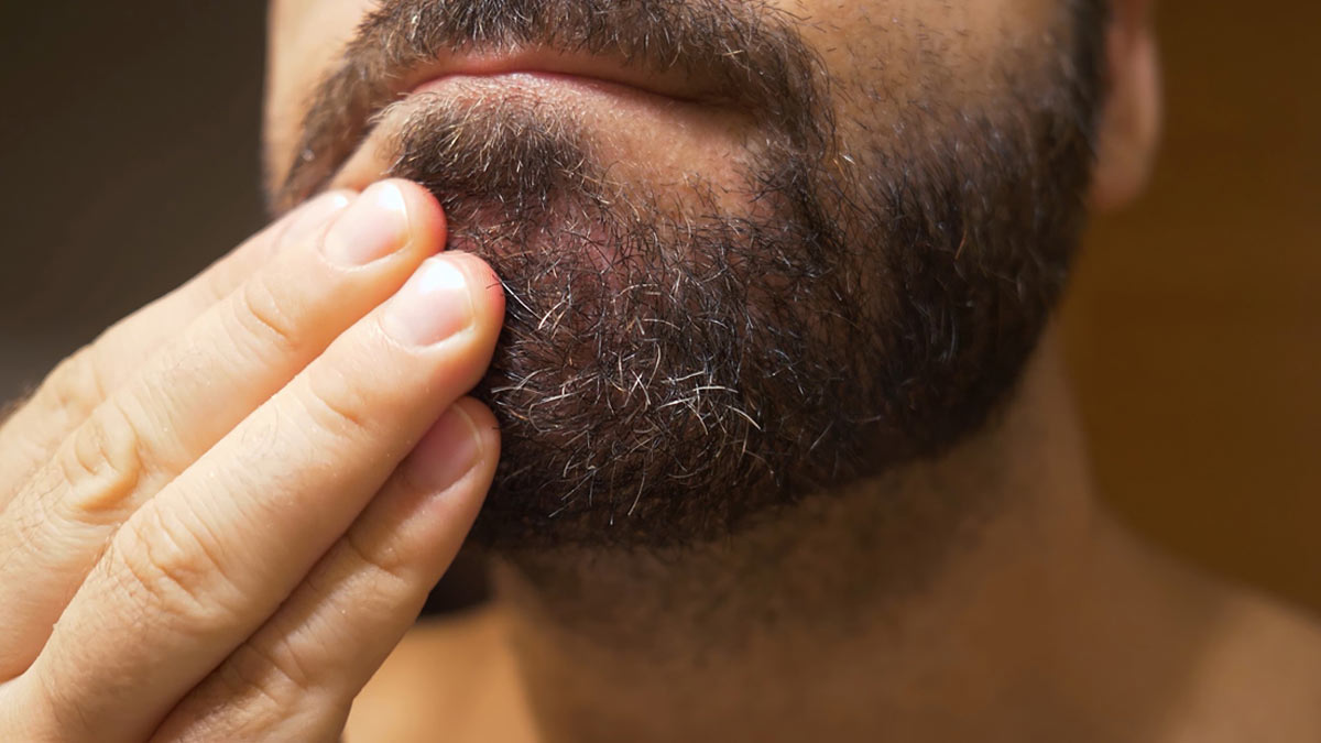 itchy beard treatment 
