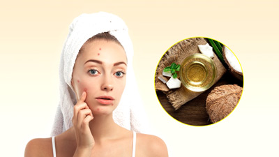 मुंहासे (Acne) से छुटकारा पाने के ल‍िए क्‍या नार‍ियल तेल फायदेमंद होता है? 