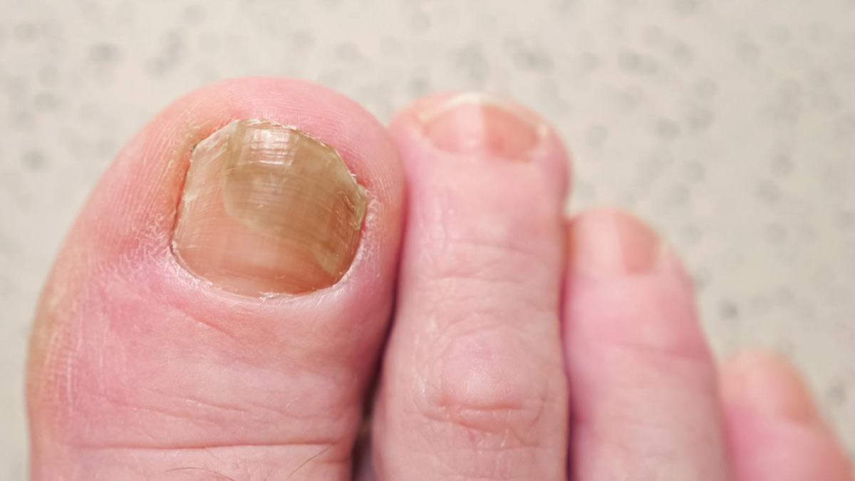 Foot Fungal Infection