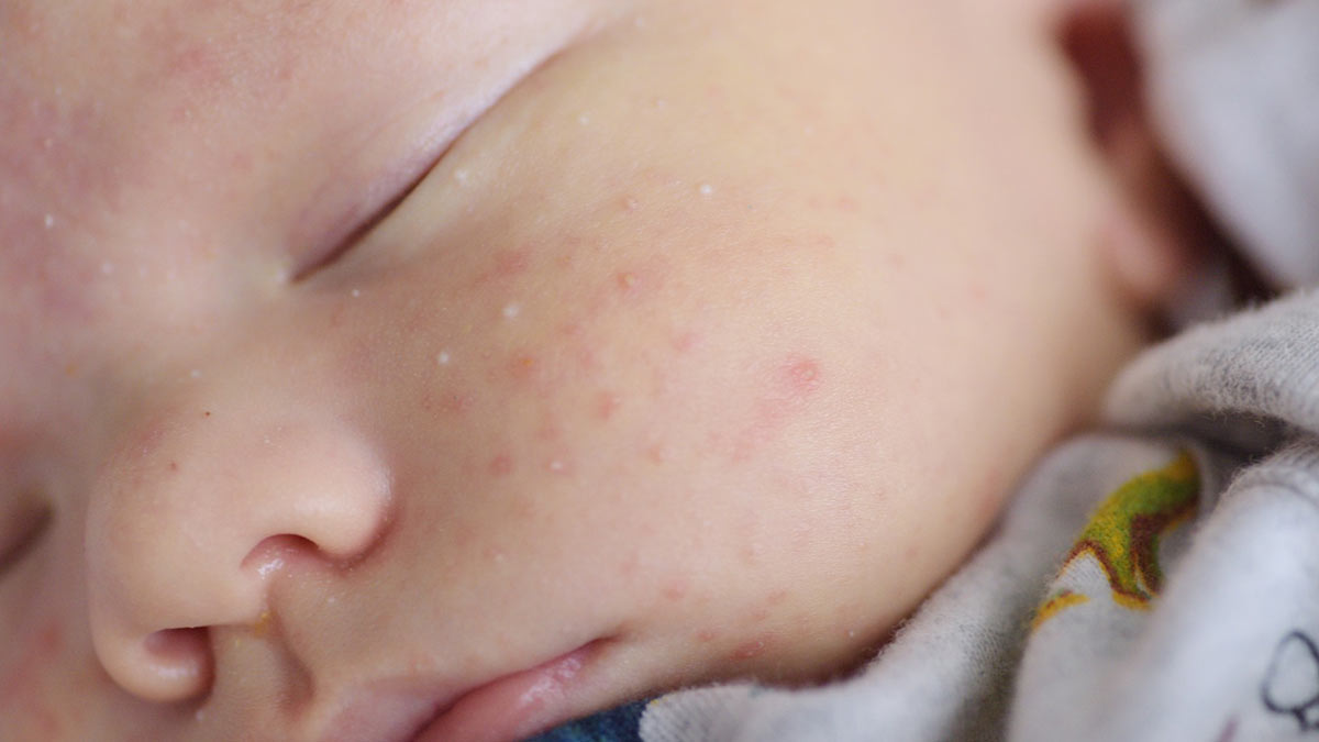 श‍िशु के चेहरे पर दाने निकलने के क्या कारण हो सकते हैं? जानें बचाव के उपाय