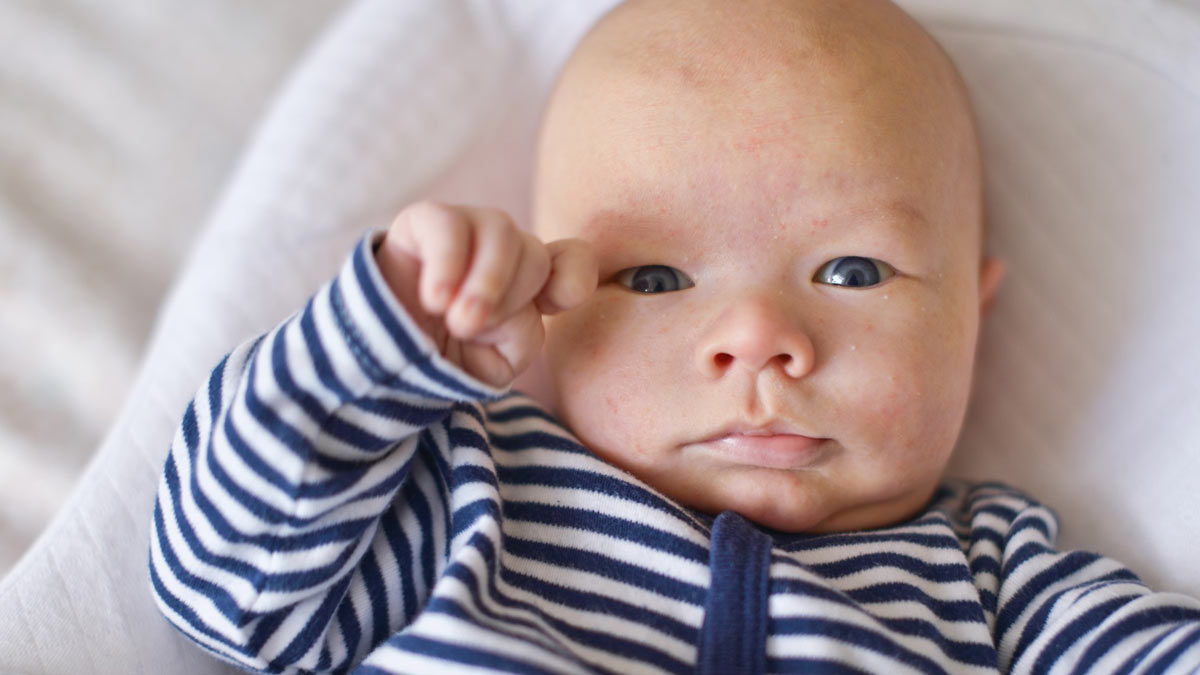 baby acne treatment 