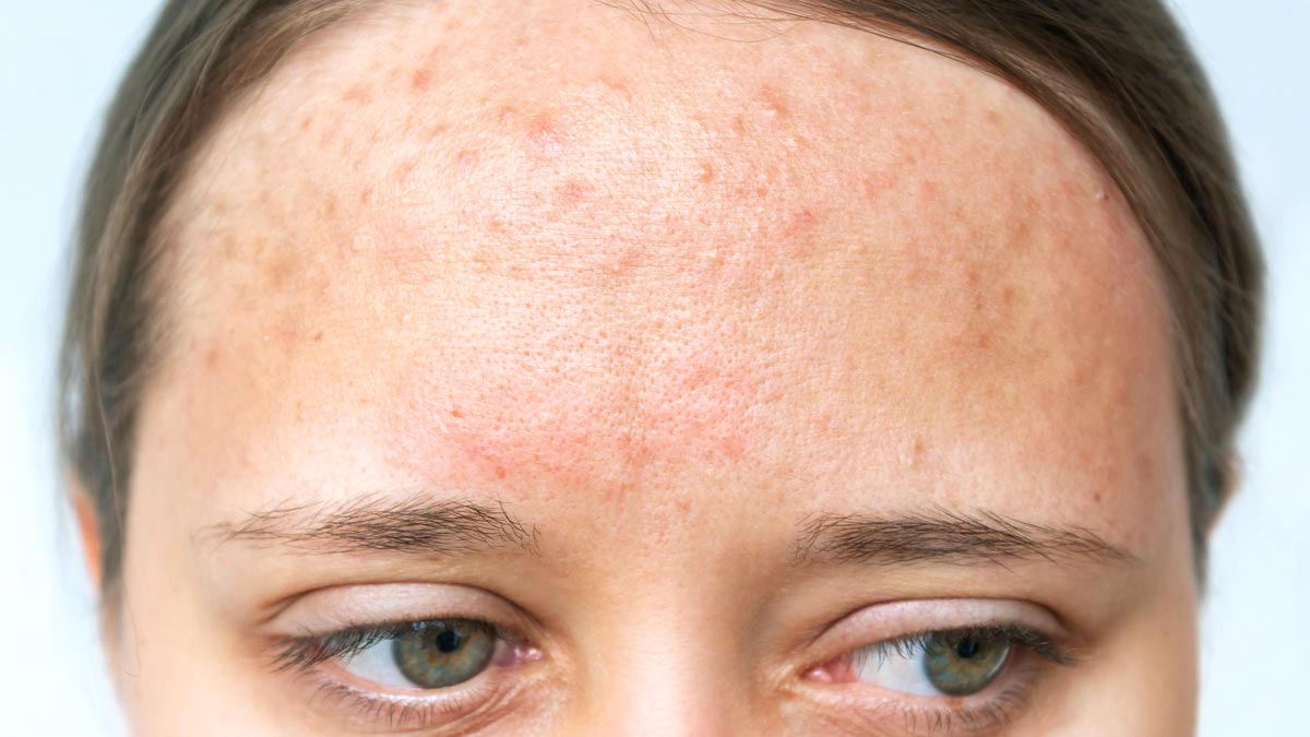 What Causes Hormonal Acne And How To Deal With It Onlymyhealth