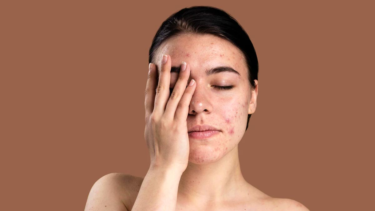 Expert Talk: What Causes Hormonal Acne and How To Deal With It