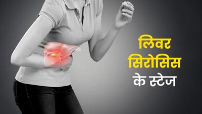लिवर सिरोसिस की बीमारी होते हैं ये 4 स्टेज, जानें इनके बारे में