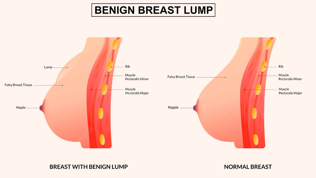 Pain and swelling in my breast - Tribune Online