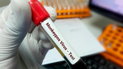Monkeypox Case in India: भारत में आया मंकीपॉक्स का पहला मामला, UAE से केरल लौटा शख्स पॉजिटिव