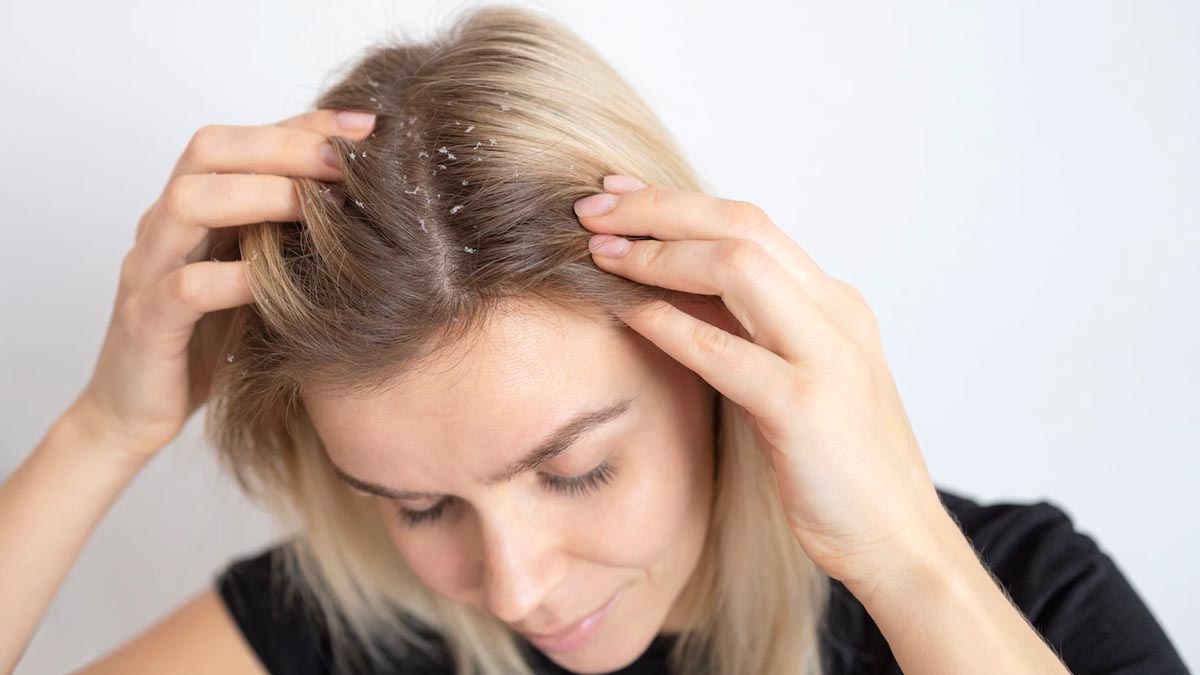 dandruff in monsoon