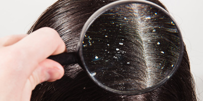 Remedies for Dandruff: मॉनसून में बढ़ जाती है डैंड्रफ की परेशानी, छुटकारा पाने के लिए अपनाएं ये 5 घरेलू नुस्खे