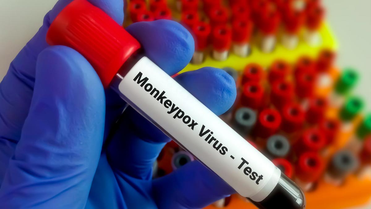 monkeypox in delhi in hindi