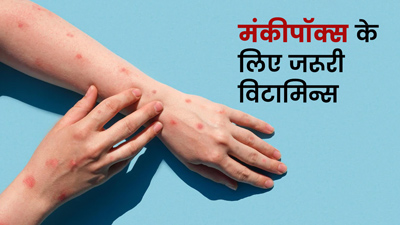 मंकीपॉक्‍स इंफेक्शन होने पर ये व‍िटाम‍िन्‍स करेंगे रिकवरी में मदद