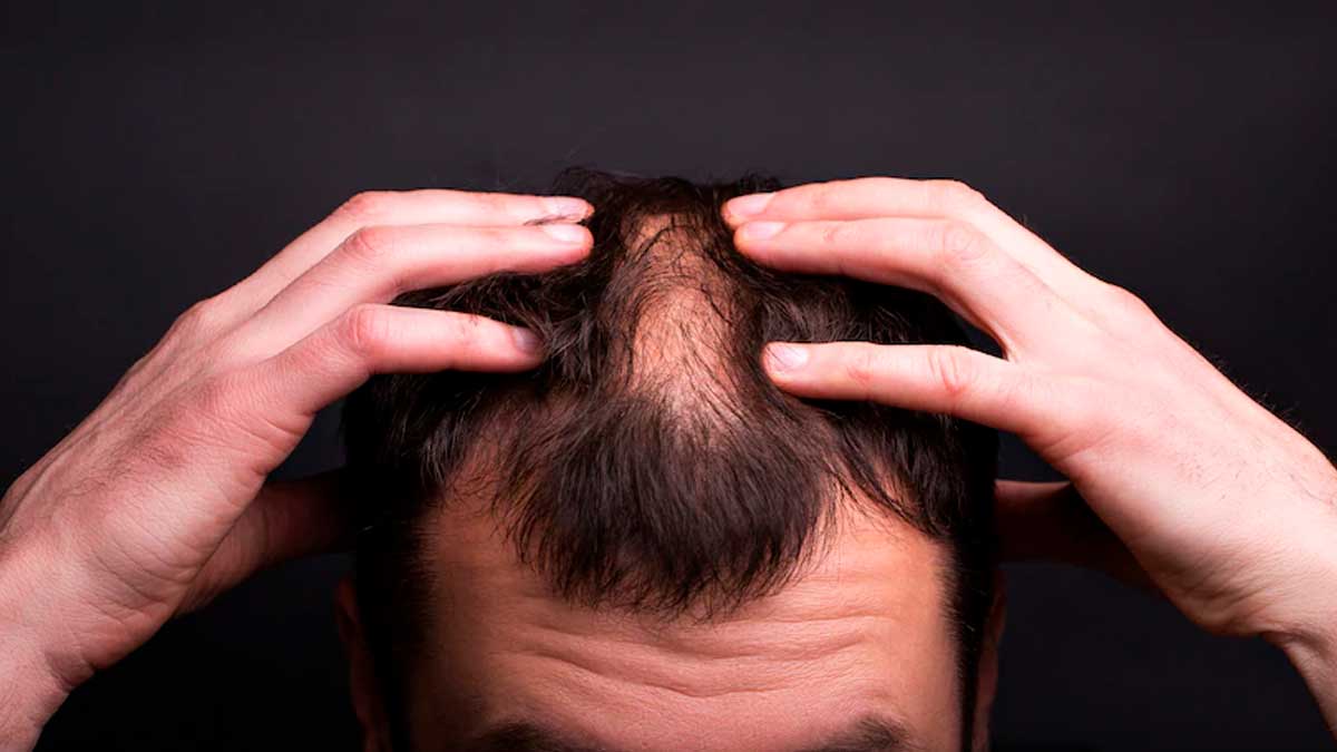 What is the Best Buzz Cut for a Receding Hairline? - Wimpole Clinic