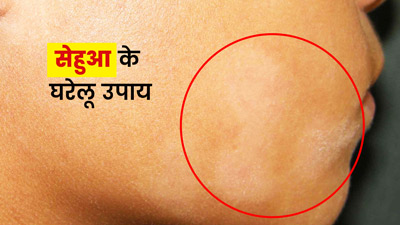 चेहरे से सेहुआ (सफेद दाग) हटाने के लिए अपनाएं ये घरेलू उपाय