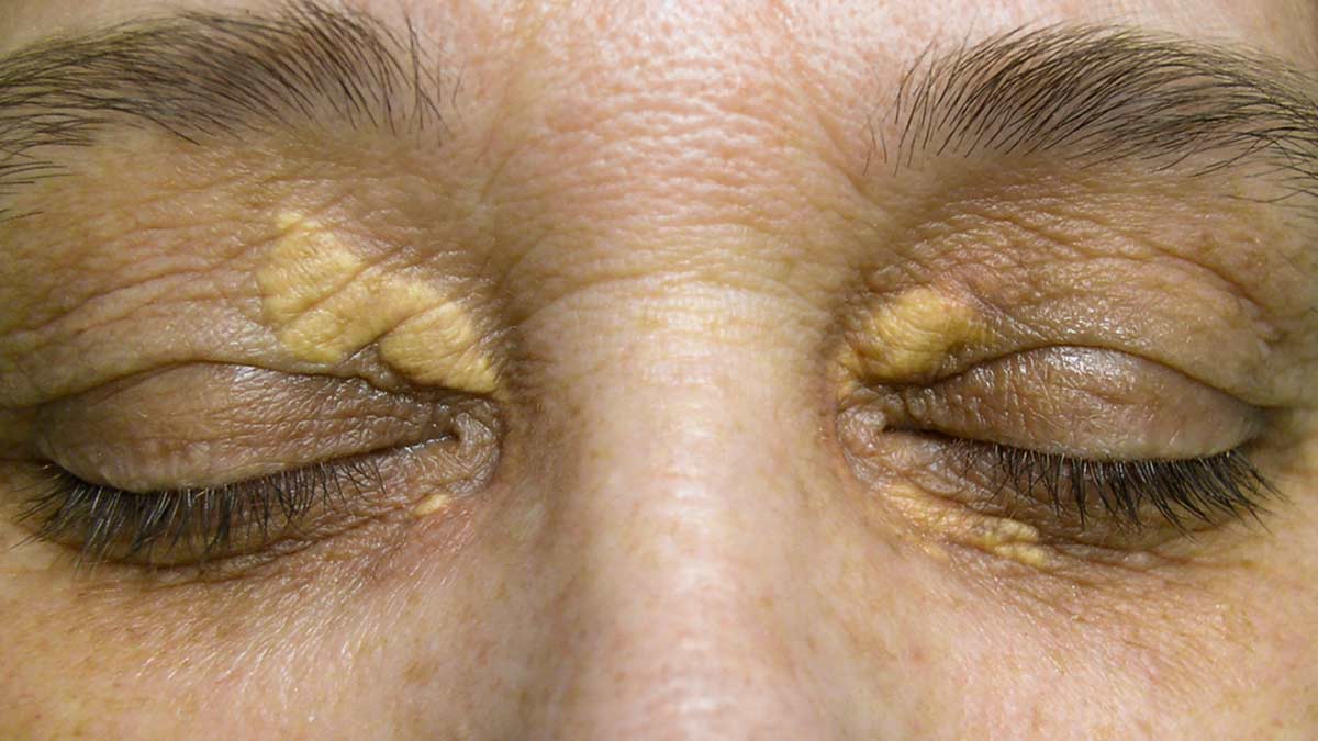 आंखों के ऊपर कोलेस्ट्रॉल जमा होने पर दिखते हैं ये लक्षण, जानें इसके कारण और बचाव