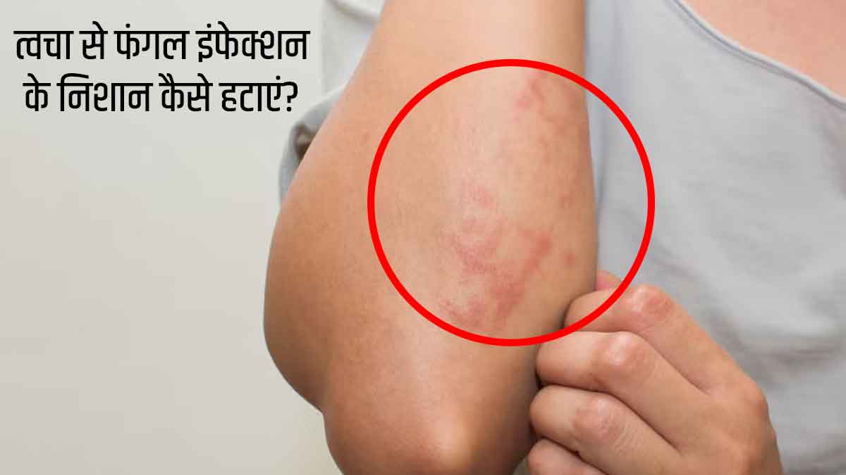 त्वचा से फंगल इंफेक्शन के निशान कैसे हटाएं? | How to Remove Fungal Infection  Marks From Skin in Hindi | Fungal Infection ke Daag Kaise Hataye