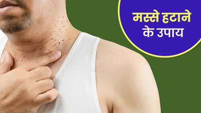 गर्दन पर मस्से क्यों होते हैं? जानें मस्सों को दूर करने के उपाय