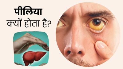पीलिया क्यों होता है? एक्सपर्ट से जानें शुरुआती लक्षण और बचाव