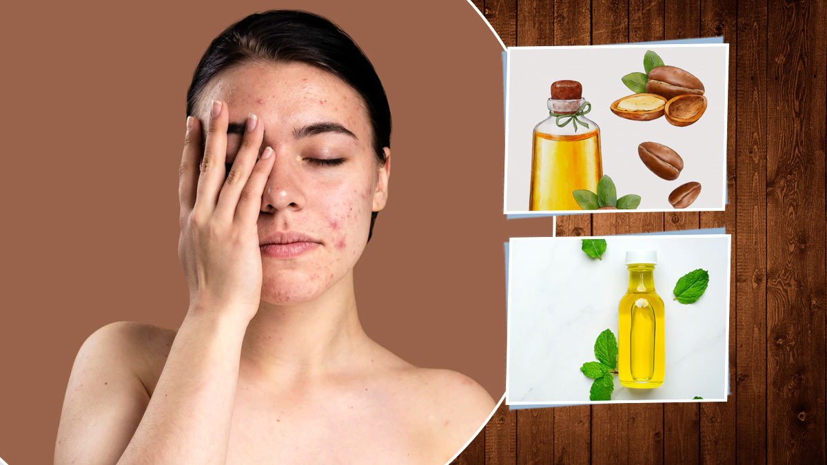 5 Natural Oils To Prevent Acne Breakouts On Face