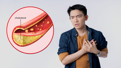 कोलेस्ट्रॉल कम करने के लिए डाइट में शामिल करें ये 5 ड्राई फ्रूट्स, कम होगा हाई बीपी और हृदय रोग का जोखिम