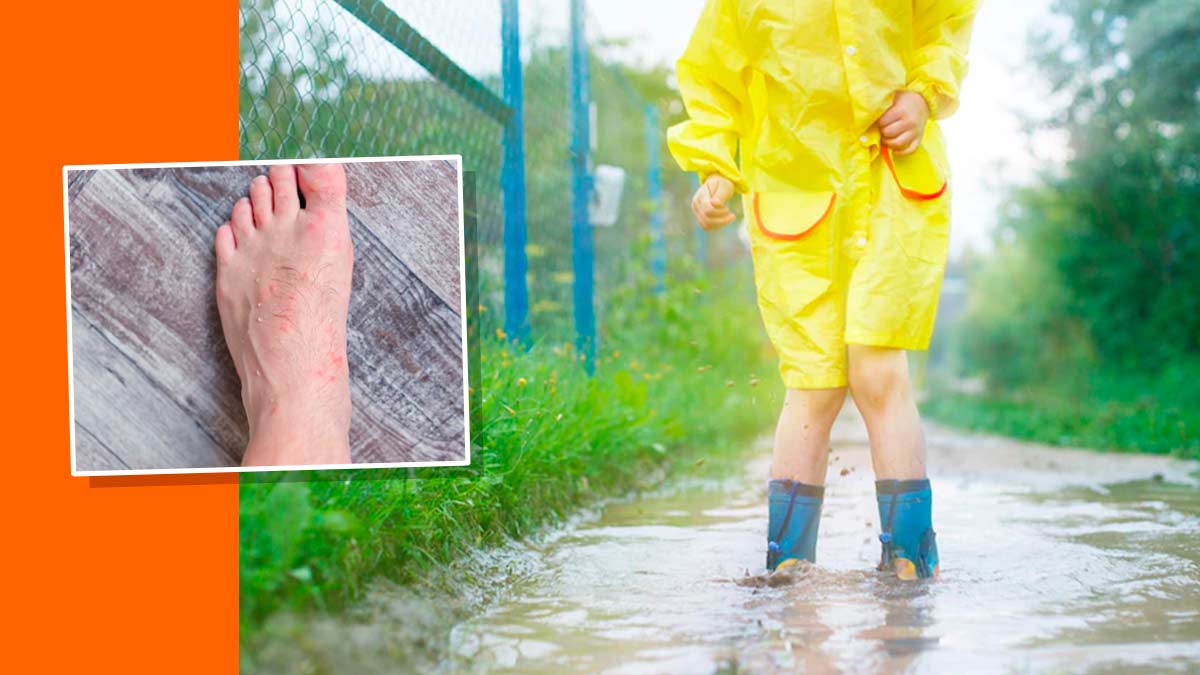 Monsoon Maladies: Why Are Foot Infections Common In Rainy Season?