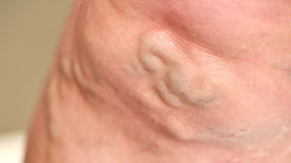 veins-blockage
