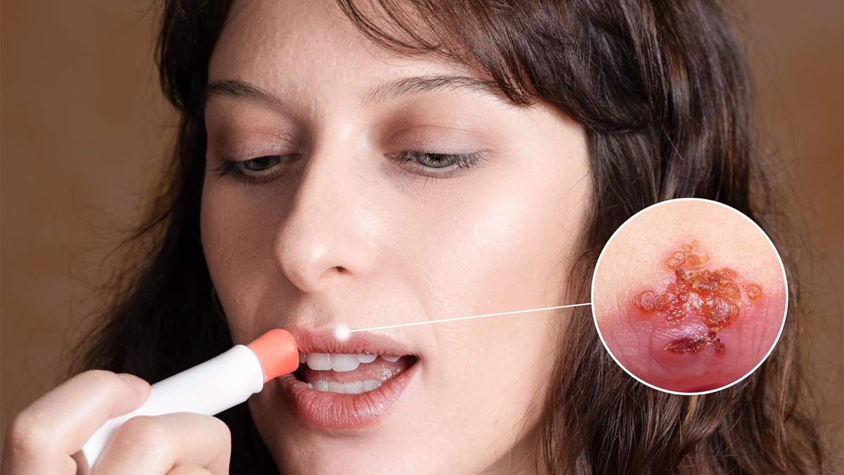 vitamin deficiency causes mouth ulcers