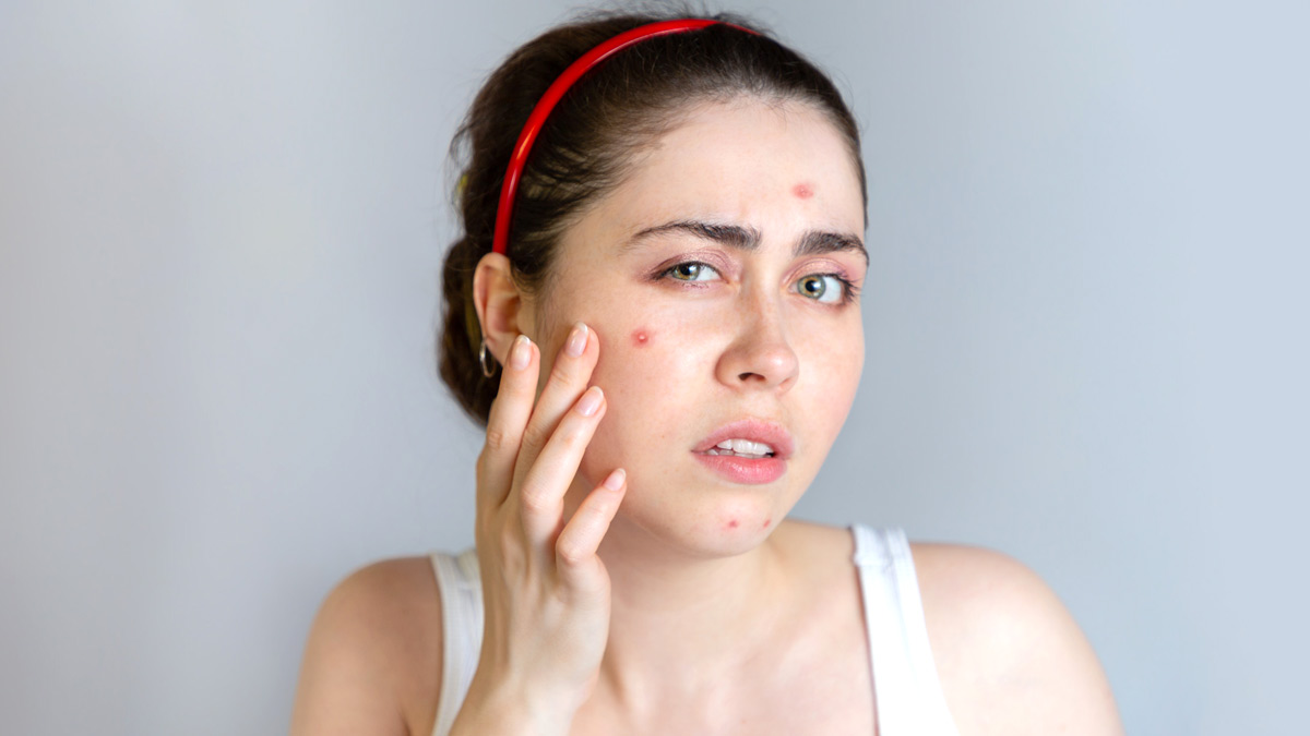 How our CEO Cured her Acne at Home