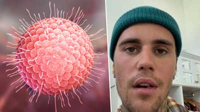 स‍िंगर जस्टिन बीबर को हुआ Ramsay Hunt Syndrome, आधे चेहरे में हुआ पैरालिसिस, जानें क्‍या है ये बीमारी
